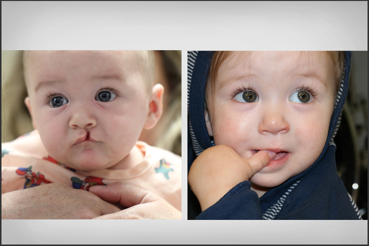 Cleft Lip Cleft Palate Craniofacial Surgery CAMC